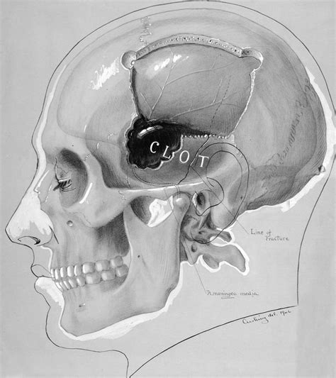 Epidural Hematoma | The Neurosurgical Atlas