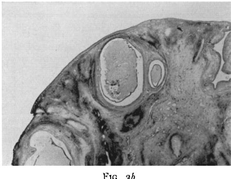 Figure 3 from Stein-Leventhal Syndrome in Sisters — The Possible Role ...