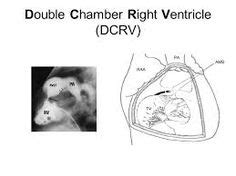 Double Chamber Right Ventricle (DCRV)