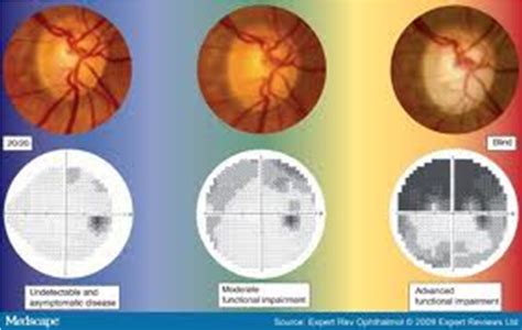 The Optic Nerve in Glaucoma | IntechOpen