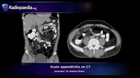 Acute appendicitis on CT - radiology video tutorial - YouTube