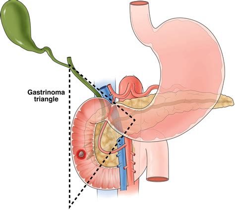 Diagnosis of the Zollinger–Ellison Syndrome - Clinical Gastroenterology and Hepatology