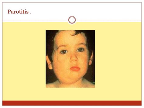 PPT - Mumps (parotitis) PowerPoint Presentation, free download - ID:622955