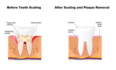 When is teeth scaling considered urgent?