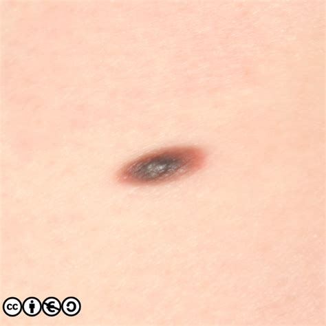 Melanoma - Skin Cancer 909