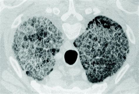 7: Diffuse parenchymal lung disease | Thoracic Key