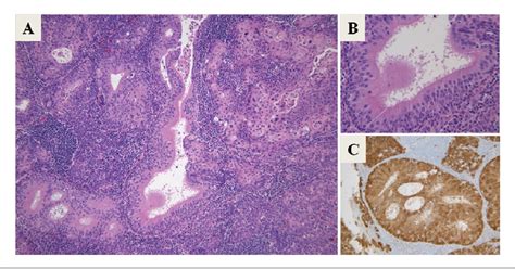 Figure Tonsillar Squamous Cell Carcinoma Associated With | My XXX Hot Girl