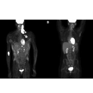 Bone marrow biopsy and aspirate showing hemophagocytosis and positive... | Download Scientific ...