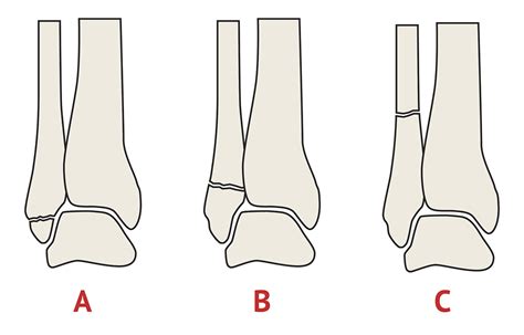 Weber Classification Fibula Fracture