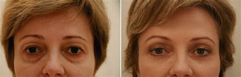 Upper and lower eyelid surgery performed on this patient, look at her # ...