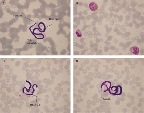 Wuchereria Bancrofti Microfilaria In A Blood Smear