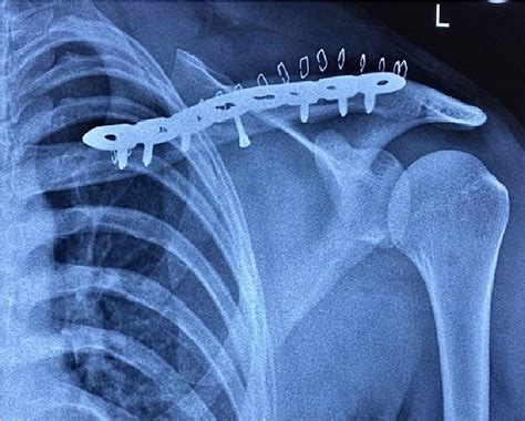 Cureus | Plate Osteosynthesis or Figure-of-Eight Brace: Which One Is ...