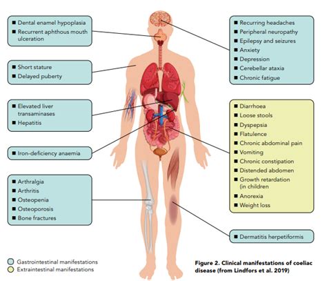 Coeliac Disease: an underdiagnosed condition that is on the rise ...