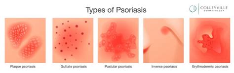 Psoriasis - Colleyville Dermatology