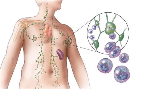 Determining Prognosis for Patients With Diffuse Large B-Cell Lymphoma ...