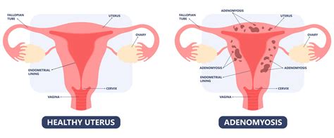 Adenomyoma - Dr. Anshumala Shukla Kulkarni