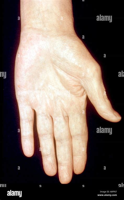 Albamv Palmar Erythema In Chronic Liver Disease | My XXX Hot Girl