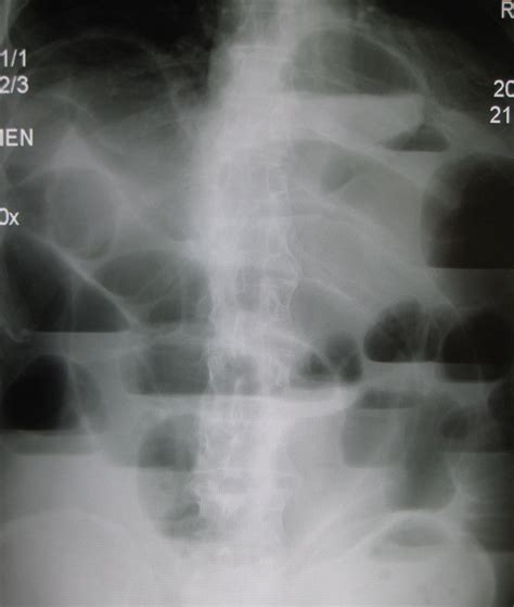 File:Upright X-ray demonstrating small bowel obstruction.jpg - Wikimedia Commons