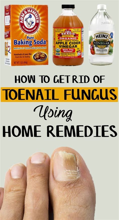 How to Get Rid of Toenail Fungus – 9 Home Remedies Included | Toenail fungus home remedies ...