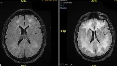 Doctors release scans of brain showing effects of cocaine use | Photo