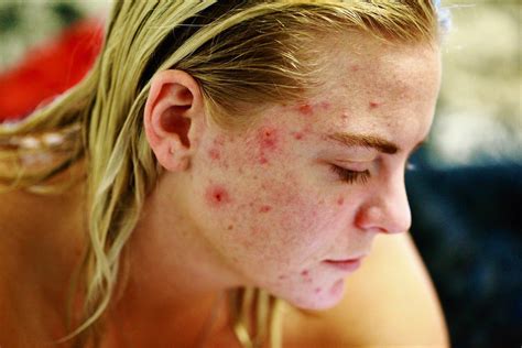 Thirteen ways to remove acne scars quickly in one day | Healthkhu.Com