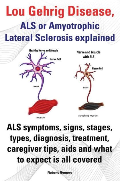 Lou Gehrig Disease, ALS or Amyotrophic Lateral Sclerosis Explained. ALS ...