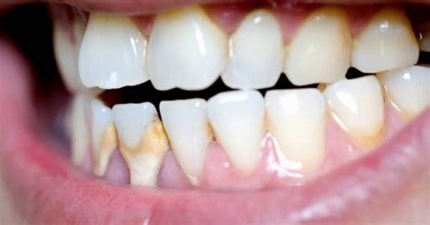 8 Easy Methods For Dental Calculus Removal At Home! Guide 2024