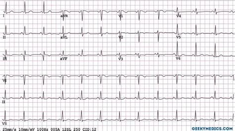 Mastro ECG paper - 8mm 0820: Buy Mastro ECG paper - 8mm 0820 at Best Prices in India - Snapdeal