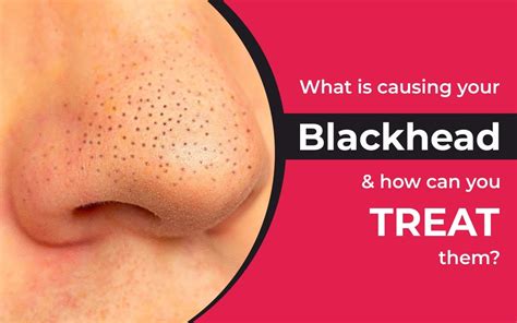 What Are The Causes Of Blackheads And How To Treat Them