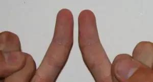 Crooked Little Finger: Causes and Remedies | IYTmed.com