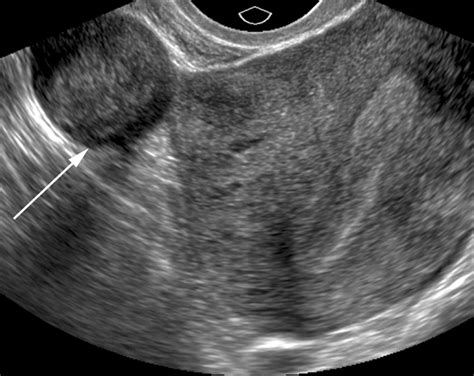 MOD 2 WK 3 pedunculated_fibroids- | Ultrasound sonography, Diagnostic ...