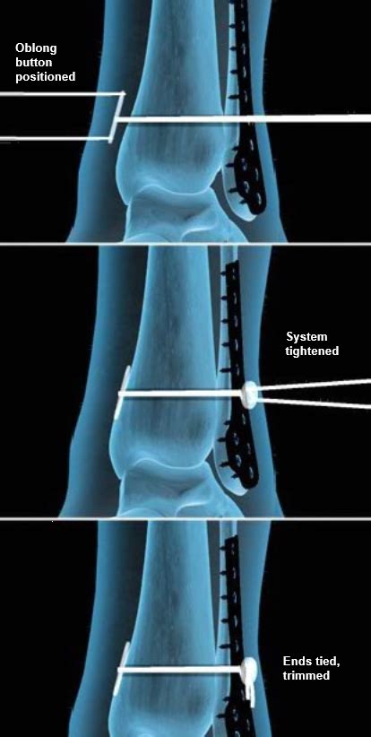 TightRope™ Fixation for Ankle Syndesmosis | Central Coast Orthopedic Medical Group