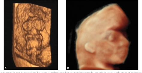 Figure 14 from Acrania-exencephaly-anencephaly sequence phenotypic characterization using two ...