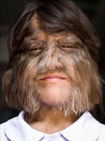 Girl with Hypertrichosis, also known as werewolf syndrome : r/interestingasfuck