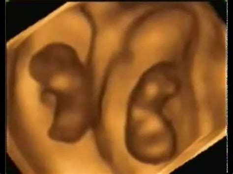 3D/4D UlTRASOUND TWINS @ 11 weeks @ A New Conception 3D Ultrasound Studio - YouTube