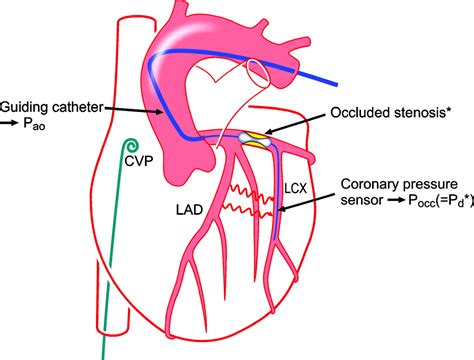 Assessment of the Human Coronary Collateral Circulation | Circulation