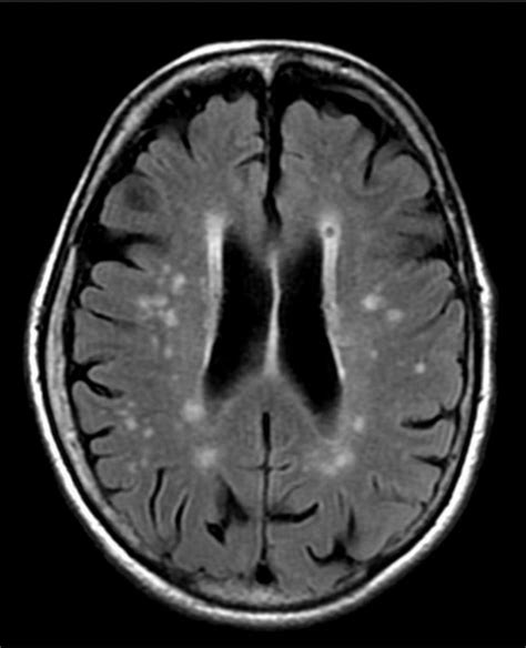 👉 Microvascular Ischemic Disease