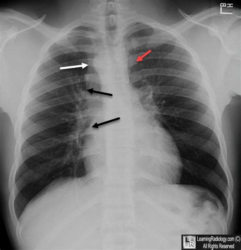 Learning Radiology - Right Aortic Arch, anomalies, mirror image