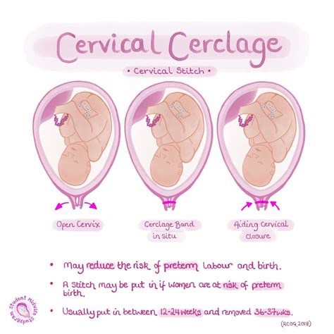 Complications Of Cervical Cerclage Medical Exhibit Medivisuals