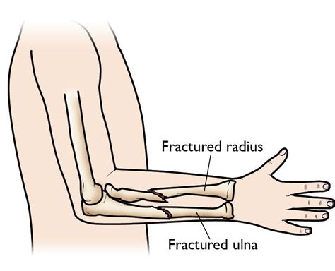 Forearm Fractures in Children - Types and Treatments - OrthoInfo - AAOS