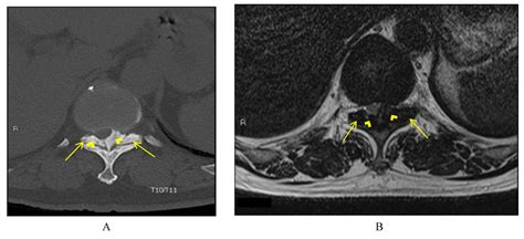 Ligamentum Flavum Hypertrophy Mri