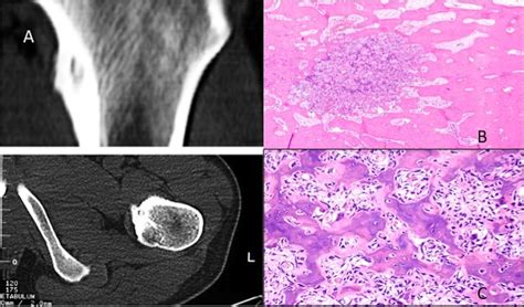 Osteoid Osteoma Histology