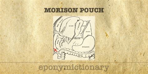 Rutherford Morison pouch • LITFL • Medical Eponym Library