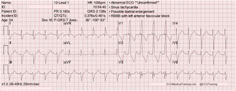 Bifascicular Block: Right Bundle Branch Block and Left Anterior Fascicular Block (RBBB/LAFB ...