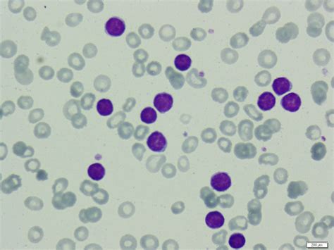 Lymphoma Peripheral Blood Smear