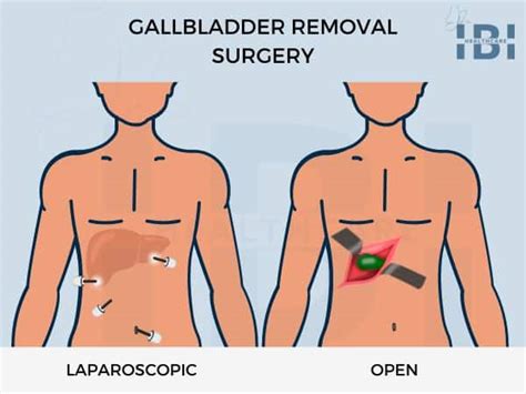 Laparoscopic Gallbladder Removal Surgery: Single-Incision