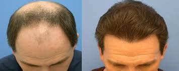 Biofibre Hair Transplant | Hair Loss Clinic in Glasgow