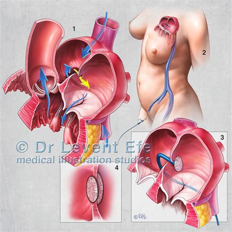 Patent Foramen Ovale Closure | Dr. Efe’s Medical Art Store: Medical ...