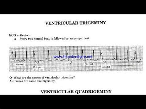 Ventricular Bigeminy, Trigeminy & Quadrigeminy - YouTube