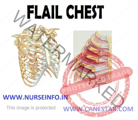 FLAIL CHEST - Nurse Info